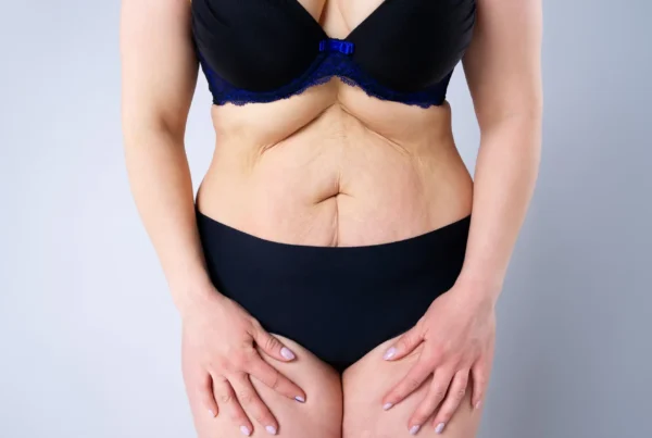 Liposuction vs Tummy Tuck: Which One Is Right for You?