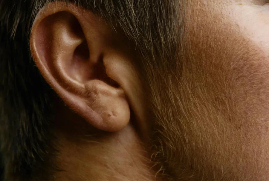 Earlobe Repair mans ears